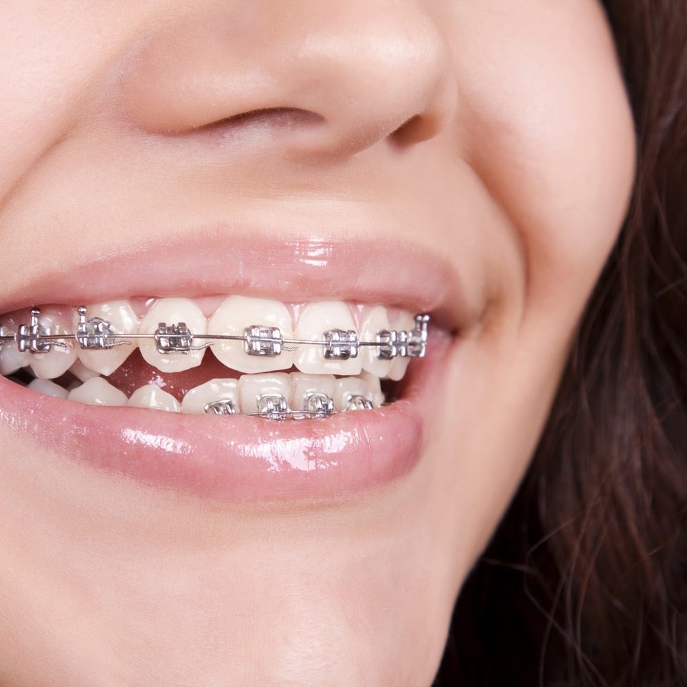 Braces & Clear Aligners (Orthodontics)