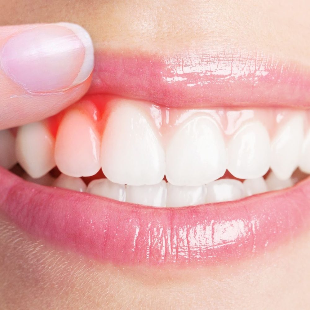 Gum Treatment (Periodontics)
