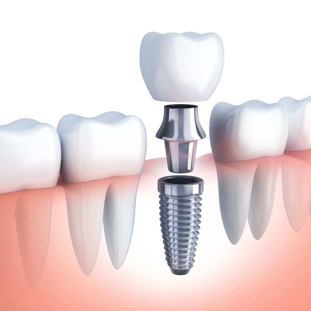 Dental Implants — Fixed Teeth Replacement